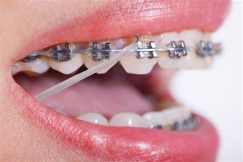 Can You Drink with Rubber Bands on Your Braces? An Unconventional Discussion